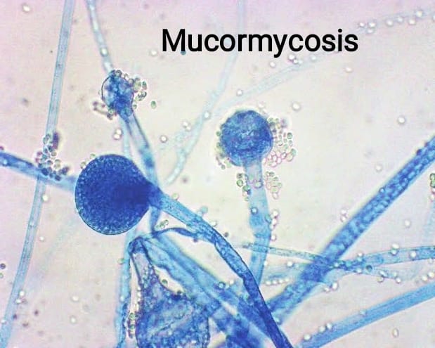 Microcare Lab Mucormycosis